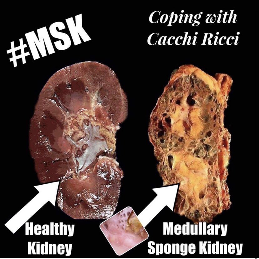 copingwithCR's tweet photo. @bellafiamma21 @hughlaurie @JStuartWolf Why MSKers are frightened😳 Never again will I tell a patient their kidney resembles “burnt toast!” https://t.co/aFEQ34GNwj