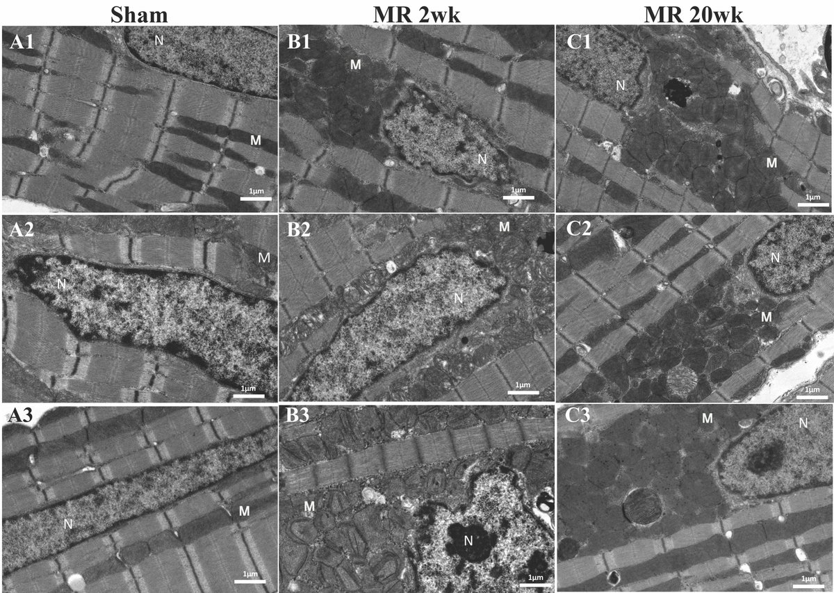 Murali Padala PhD (@padalalab) on Twitter photo Our new work on the adaptation of the cardiomyocyte to chronic mitral regurgitation. As treatment options to repair MR increase, a physiological basis for MR repair is much needed. frontiersin.org/article/10.338… <a href="/EmoryCTSurgery/">Emory Division of Cardiothoracic Surgery</a> <a href="/kanikakalra_MD/">Kanika Kalra MD</a> <a href="/MichaelHalkos/">Michael Halkos MD, MSc</a> <a href="/padalalab/">Murali Padala</a> Our new work on the adaptation of the cardiomyocyte to chronic mitral regurgitation. As treatment options to repair MR increase, a physiological basis for MR repair is much needed. frontiersin.org/article/10.338… <a href="/EmoryCTSurgery/">Emory Division of Cardiothoracic Surgery</a> <a href="/kanikakalra_MD/">Kanika Kalra MD</a> <a href="/MichaelHalkos/">Michael Halkos MD, MSc</a> <a href="/padalalab/">Murali Padala</a>