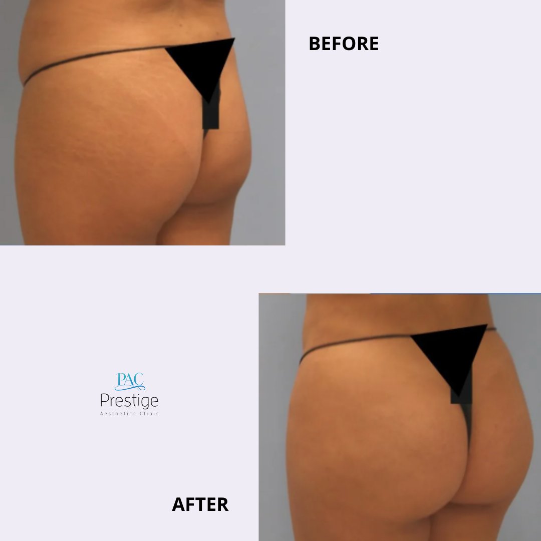 pacboca's tweet image. BBL can enhance the natural curves for patients who are unhappy with the shape or lack of fullness of their buttocks. A butt lift can add volume and roundness to your silhouette 🍑👉 bit.ly/3638Swm

#confident #fattransfer #bocamom #bocalife #bbl #liposuction #lipo