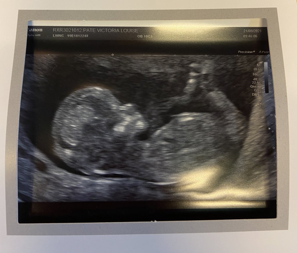 so after a 6 year battle with fertility treatment, failed ivf’s, surgery, miscarriage and blood sweat and tears we can finally announce that our Little Rainbow Miracle will be arriving in March 2022!! <a href="/vickypate82/">Vicky Pate</a>