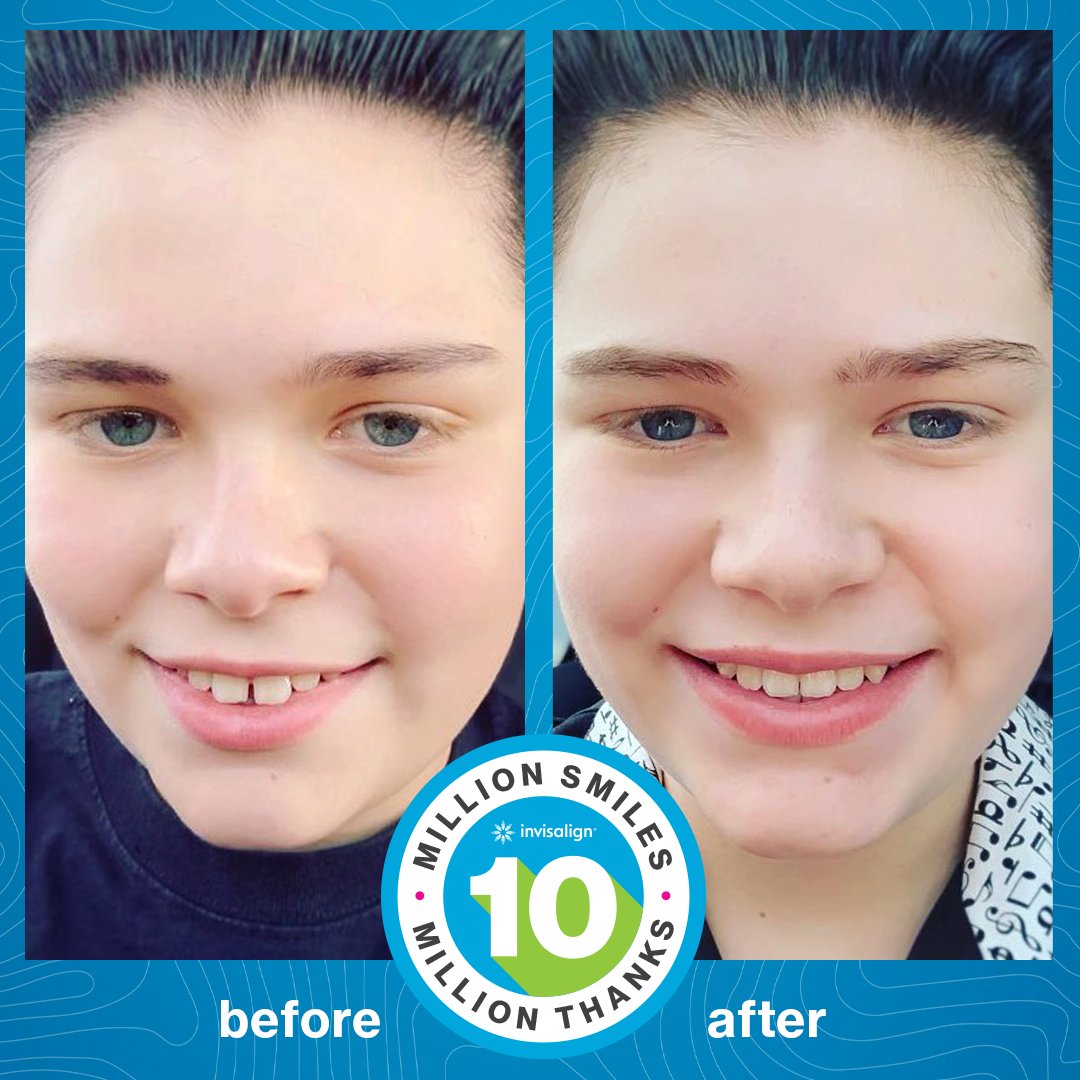 Invisalign's tweet image. It’s #TransformationTuesday, check out these results that will have you smiling!😊

📸 finleywatkins08

#invisalign #invisalignsmile