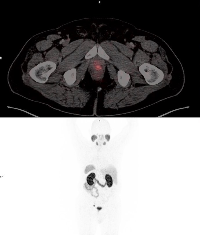 🚨El PET PSMA es un tipo de imagen molecular usada en cancer de la próstata y ha sido incluido recientemente en las guías de NCCN 2022, gracias programas como <a href="/OPUS/">opus</a> en #INCAn sa ha logrado que más pacientes tengan el acceso este tipo de modalidades de imagen.