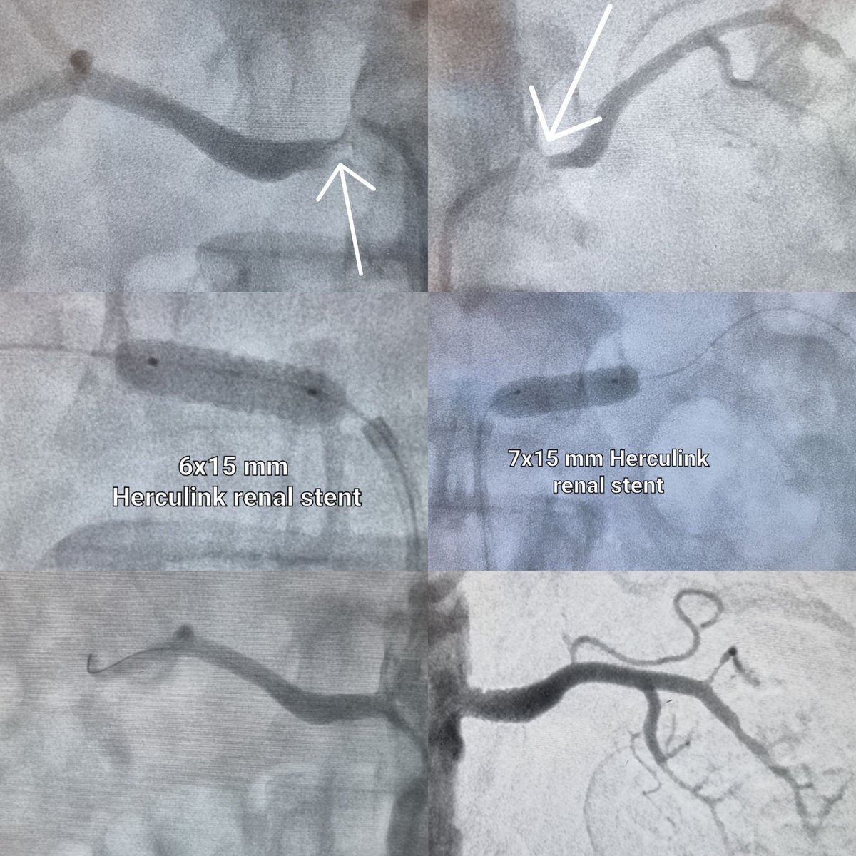 200/110 mmHg, despite 4 drugs.  progressive creatinine rise.Bilateral atherosclerotic osteal renal artery stenosis.we revascularized in the same session.Did anyone say I wouldn't open it? What would you do if it were you?