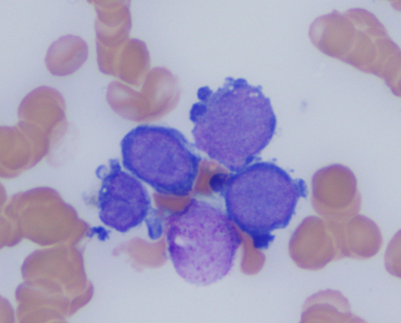 NicholasWardMD's tweet photo. 75 y/o history of MDS
-Flow cytometry CD45(dim+), CD34(-), HLA-DR(-), CD42b(-) and CD61(-)
-Complex cytogenetics; NGS x2 p53 mutations
-Core biopsy and aspirate smears https://t.co/JfEOV00l6S