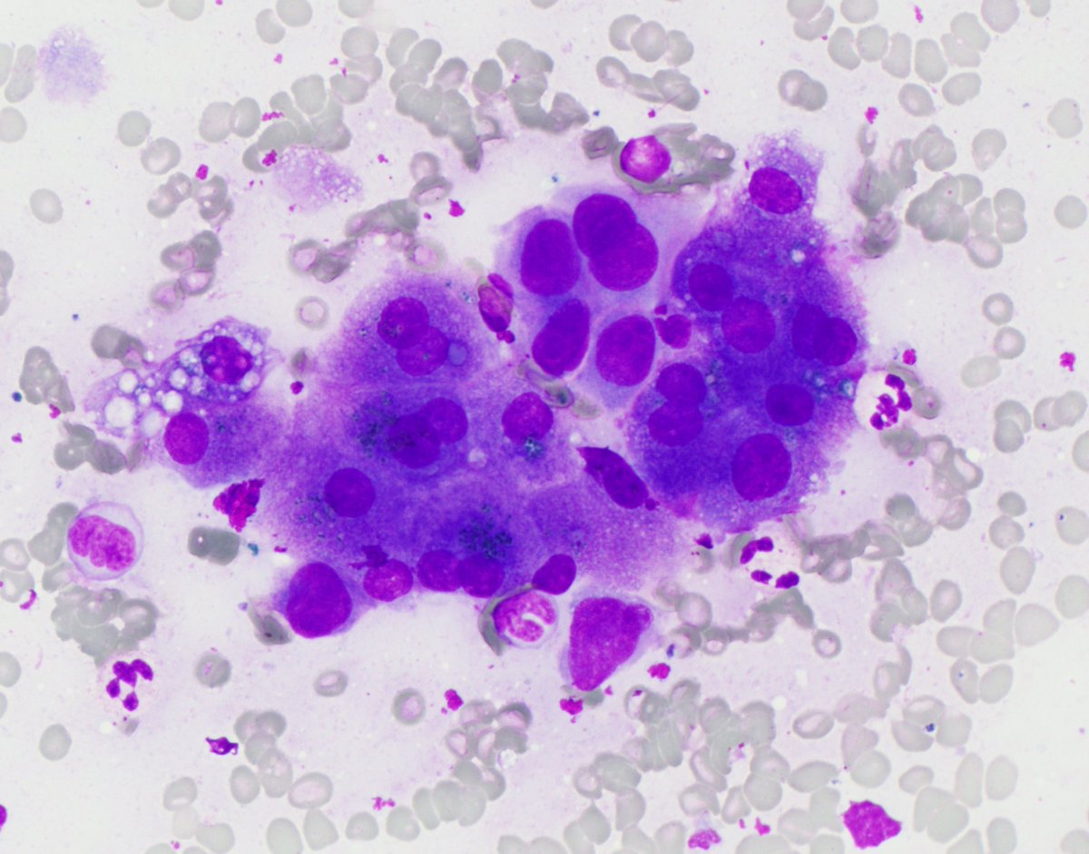 HubertLauMD's tweet image. You can run, but you can&apos;t hide: metastatic pancreatic adenocarcinoma hiding amongst benign hepatocytes

#CytoPath #FNApath