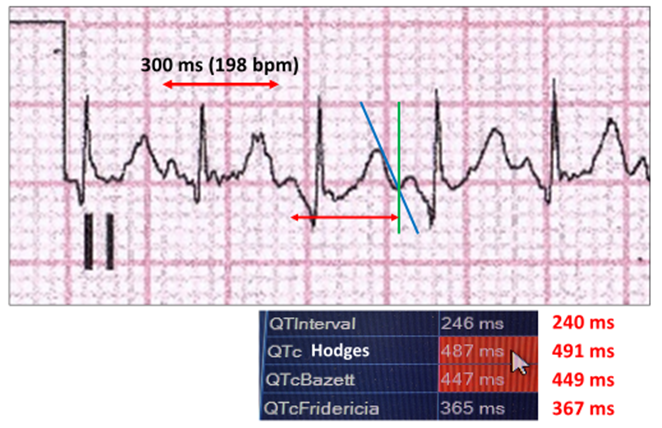 cardioscanUK's tweet photo. While the QT Interval is a topic that few #Cardiologists are experienced in, we review several aspects including, how it can be measured, while discussing some of the surrounding controversies.  Read more: https://t.co/zUabXPpXy4 #ECG #Cardiology https://t.co/tG2df8Hoai
