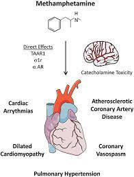 alicejessy10's tweet photo. Angiology: Open Access https://t.co/Zc3l0OHX8a
Methamphetamine use drove surge in #heart failure hospitalizations, costs in California
#cardiotweets #heart https://t.co/nayN2ifSGc