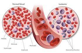 RestingUser2's tweet photo. #Headline New findings show that common pesticides at home could increase a child's risk of getting #Leukaemia by up to 47% @Lotusfm #sabcnews https://t.co/h6uxWXIqfF