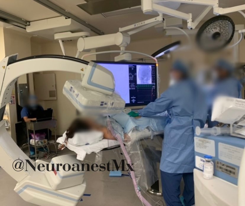 NeuroanestMx's tweet photo. #radiationday
Female 18 years old. Headache 4 months of evolution.
#arteriovenous malformation #cerebral #spetzlermartin grade III
#anesthesiacases
#neuroanesthesia
#endovascularneurosurgery
#neurophysiologicalintraoperativemonitoring
#ionm
#neurotwitter
#medtwitter https://t.co/WSo3CDIS8O