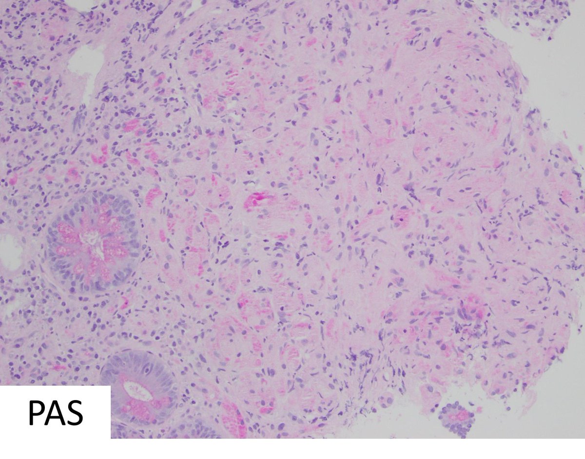 1/2

R Colon polyp:  Granular cell tumour

- Plump cells, bland nuclei, granular cytoplasm
- PAS/PASD+, S100+, can be TFE-3+ (no gene rearrangement)

#PathTwitter, #PathResident, #GIPath, <a href="/DrJohnCiciulla/">Dr John Ciciulla</a>