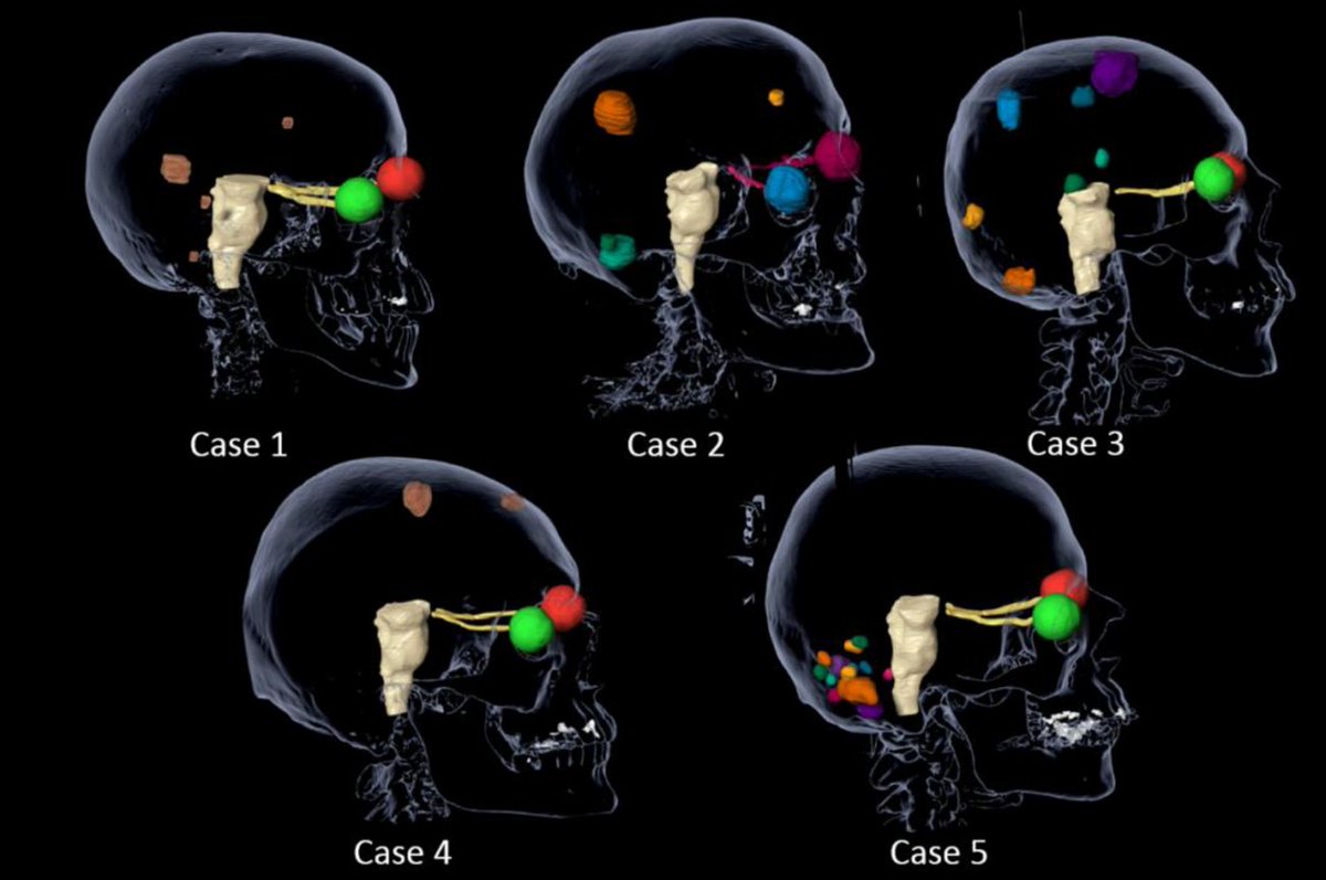 BJR|Open paper
Treatment of multiple intracranial metastases in radiation oncology: a contemporary review of available technologies
bit.ly/3nHCPwK
#Radiology #RadOnc #FOAMed