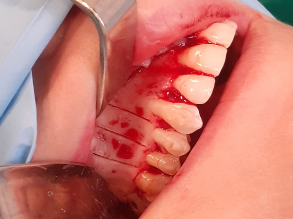 gayescoda's tweet photo. Les mostramos un caso clínico de Corticotomías alveolares para facilitar el tratamiento ortodóncico, con el uso de las puntas ultrasónicas. Corticotomías complementadas con regeneración ósea de la cortical vestibular con xenoinjero y hueso autólogo (1:1). https://t.co/YmdZu3eaCb