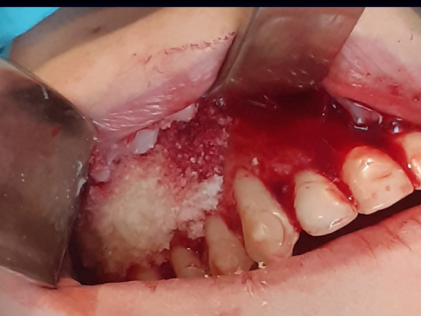 gayescoda's tweet photo. Les mostramos un caso clínico de Corticotomías alveolares para facilitar el tratamiento ortodóncico, con el uso de las puntas ultrasónicas. Corticotomías complementadas con regeneración ósea de la cortical vestibular con xenoinjero y hueso autólogo (1:1). https://t.co/YmdZu3eaCb