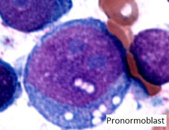 NicholasWardMD's tweet photo. Pure erythroid leukemia 
->80% marrow erythroid cells (>30% pronormoblasts); no increase myeloblasts 
-Rare (~1% AML), aggressive course
-Pronormoblasts - large, pale blue cytoplasm, open evenly distributed chromatin and prominent nucleoli 
-Complex karyotypes ~almost all cases https://t.co/LN1G33ZVWP