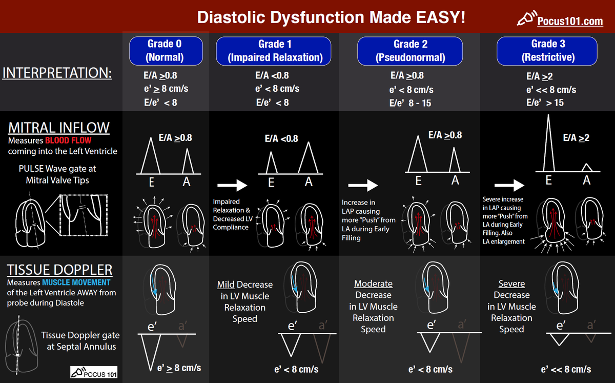 ERitterMD's tweet photo. An excellent guide to understanding findings of diastolic dysfunction on TTE by POCUS 101. Useful for better understanding my patient's reports and hopefully a POCUS skill I will acquire. https://t.co/tF5QV89CwA https://t.co/O5iFhkojOd