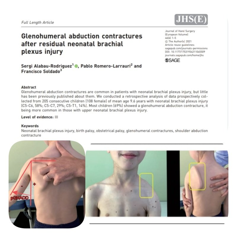 dralabau's tweet photo. New @icat_ma paper about "Glenohumeral abduction contractures after neonatal brachial plexus injuries" - JHSE #icatma #icatme #brachialplexus https://t.co/1vhxtky79n