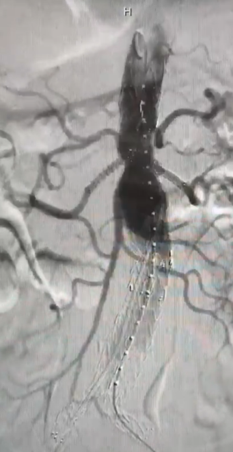 Anatomía por radiología  

Aorta abdominal tratada con prótesis endovascular fenestrada. 

Endovascular aneurysm repair (EVAR)
