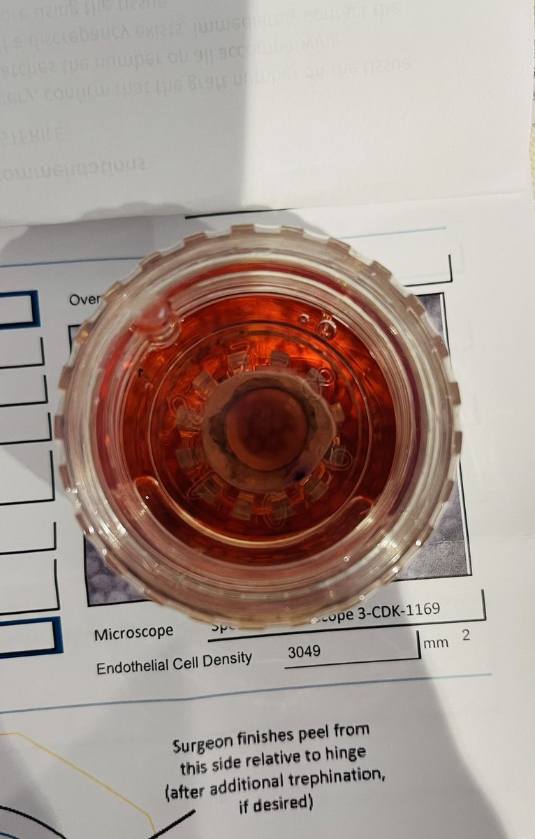 More isn’t always better, but it certainly is when it comes to the transplanted corneal endothelial cell number in DMEK surgery for #FuchsDystrophy <a href="/oclvision/">OCL Vision</a>
