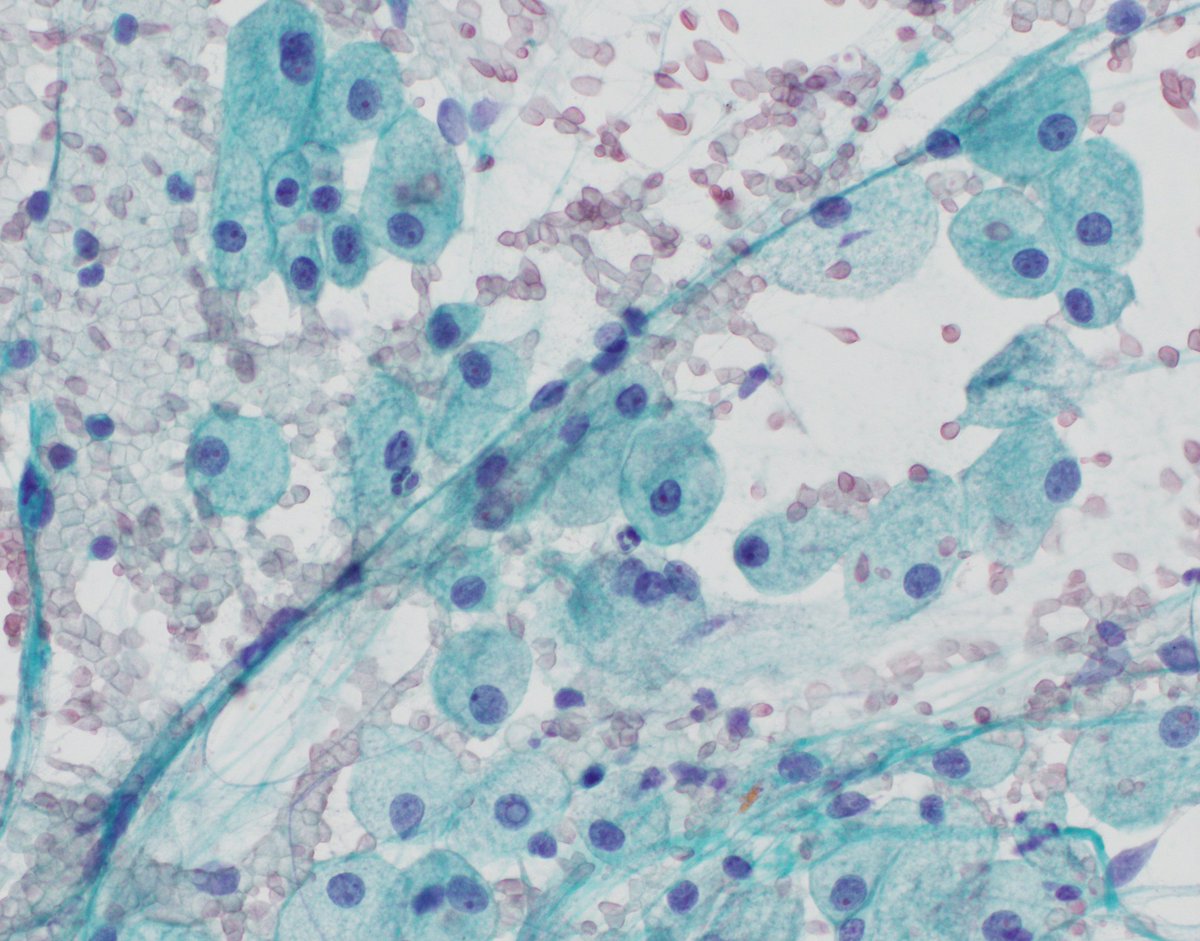 HubertLauMD's tweet image. Chromophobe renal cell carcinoma captured beautifully by #FNApath

#GUpath #CytoPath