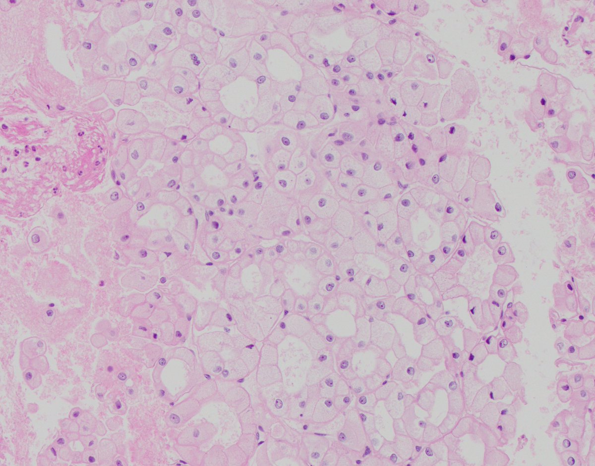 HubertLauMD's tweet image. Chromophobe renal cell carcinoma captured beautifully by #FNApath

#GUpath #CytoPath