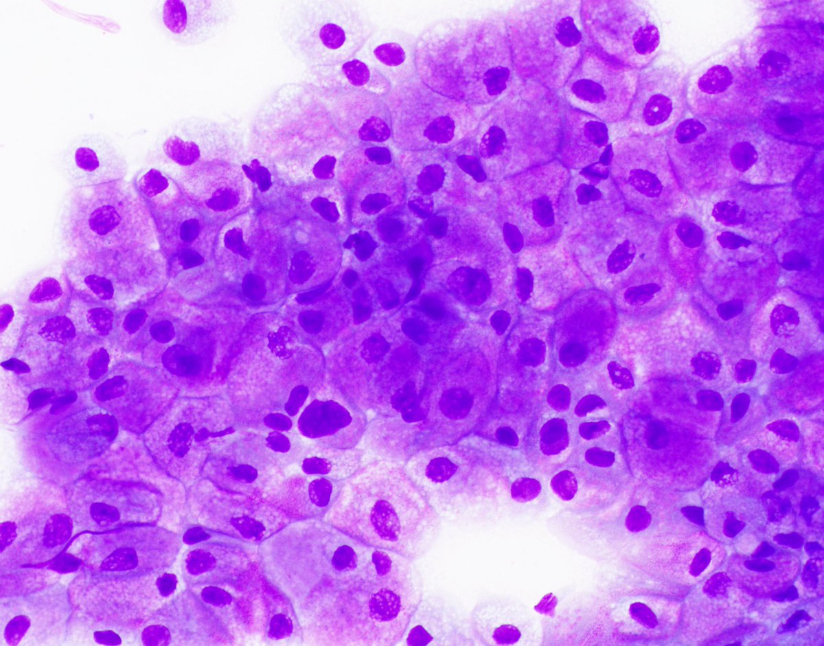 HubertLauMD's tweet image. Chromophobe renal cell carcinoma captured beautifully by #FNApath

#GUpath #CytoPath