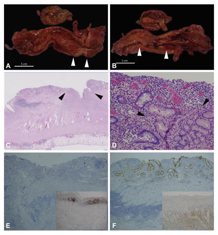 JACIInPractice's tweet image. In Current Issue! #Crohn’s-like #Enteritis in X-Linked #Agammaglobulinemia: A Case Series and Systematic Review buff.ly/3fEnwPS