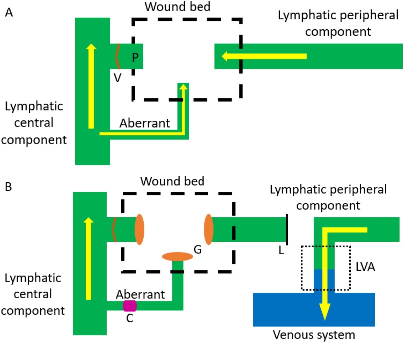 PARjournal's tweet image. #Lymphaticovenular- #anastomosis treatment of the peripheral component in #chyle #leakage after axillary surgery: case report and review
parjournal.net/article/view/4…
The supermicrosurgery technique as a surgical therapeutic option for chyle leakage were introduced.