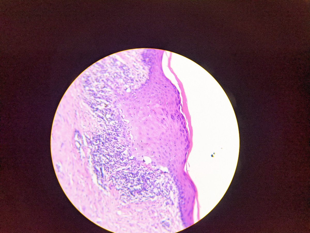 vicvise2's tweet image. - Lesión única: queratosis liquenoide.
- Lesiones múltiples: liquen plano.
- Erupción generalizada: toxicodermia liquenoide.
#MorphologyMatters #ClinicalDataMatters #DermPath