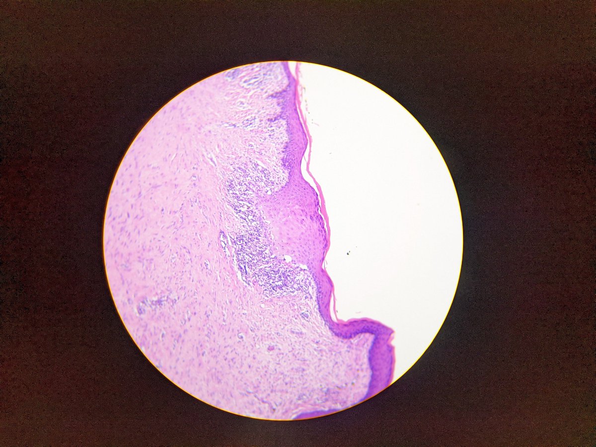 vicvise2's tweet image. - Lesión única: queratosis liquenoide.
- Lesiones múltiples: liquen plano.
- Erupción generalizada: toxicodermia liquenoide.
#MorphologyMatters #ClinicalDataMatters #DermPath