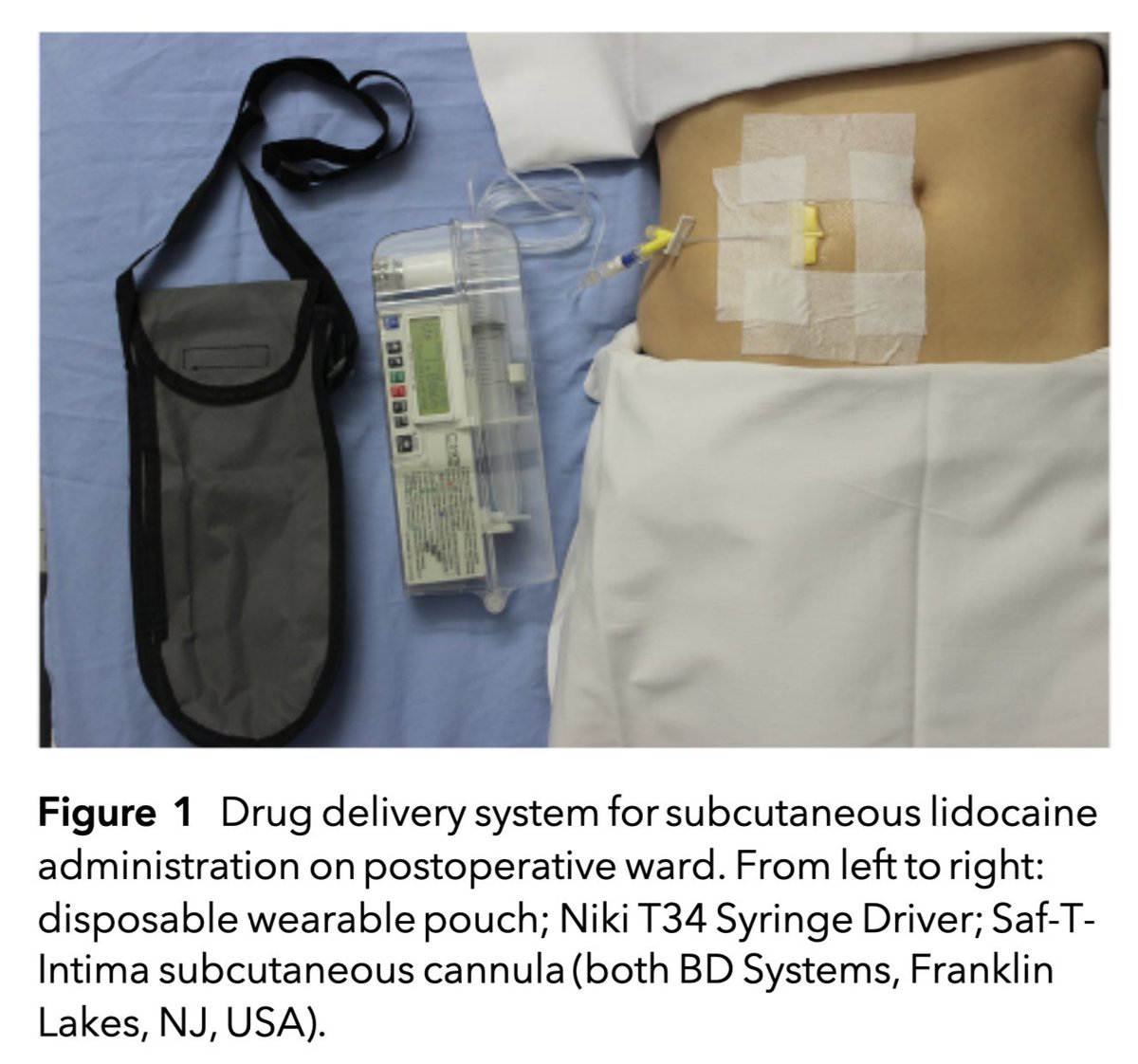ππ―π’π¦π΄π΅π©π¦π΄πͺπ’ (@anaes_journal) on Twitter photo πThis pilot study from <a href="/Tomundoc/">Tomas Corcoran</a> confirms that a lidocaine trial design addresses the limitations of previous studies, overcomes existing translational barriers, is safe, effective and feasible in patients undergoing breast cancer surgery.
πβ¦-publications.onlinelibrary.wiley.com/doi/10.1111/anβ¦ πThis pilot study from <a href="/Tomundoc/">Tomas Corcoran</a> confirms that a lidocaine trial design addresses the limitations of previous studies, overcomes existing translational barriers, is safe, effective and feasible in patients undergoing breast cancer surgery.
πβ¦-publications.onlinelibrary.wiley.com/doi/10.1111/anβ¦