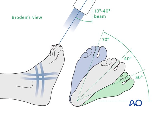 WWerszner's tweet image. I was at Fracture Clinic this week, it was a bit challenging at times. I had to ask my colleagues for help with some rare projections such as Broden’s view to demonstrate subtalar joint. Now…time to start AL🥰✌🏼. 
#RadDiary #askingforhelpisok 
[Source: surgeryreference.aofoundation.org/orthopedic-tra…].