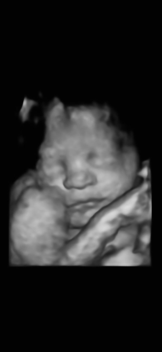 My beautiful little girl - can’t wait to meet you soon #36weeks #miraclebaby