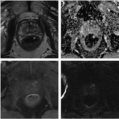 AuntMinnieEuro's tweet image. #multiparametric MRI on 3T units showed little advantage over 1.5T imaging in a direct comparison in prostate cancer patients with total hip replacements. The German study was posted in EJR on 11 Sept. buff.ly/3hzbMA0 #radiology #musculoskeletal @ELS_Radiology @ESSRmsk