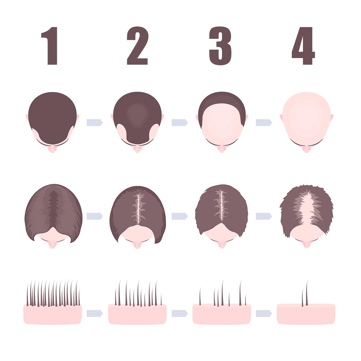 There are hair restoration solutions for every stage of hair loss. Whether you are just starting to notice thinning hair or you've been bald for 20 years, we can get you the look you want.  Stop in for a free scalp evaluation and learn about your options! #hairloss