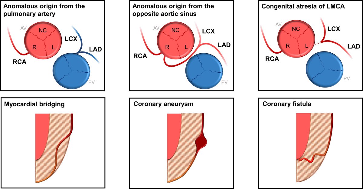 #InDepth Review highlighting current diagnostic and therapeutic approaches to Coronary Artery Anomalies  ow.ly/4MPB50GeHY8 #AHAJournals