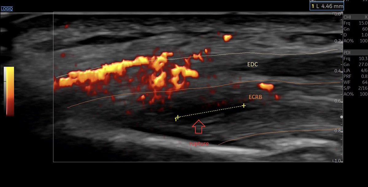 SportklinikBern's tweet photo. #epicondylopathy humeri laterlais with #neovascularization and #partialrupture in the Beauty of #e10r2 #mskus #pocus #pocushub https://t.co/Gk1NgKbqla