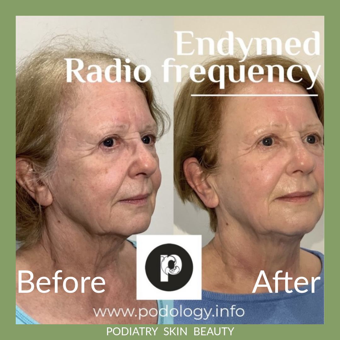 The results are in! Endymed is the treatment of choice in anti ageing. - mailchi.mp/e8824086d9db/t…