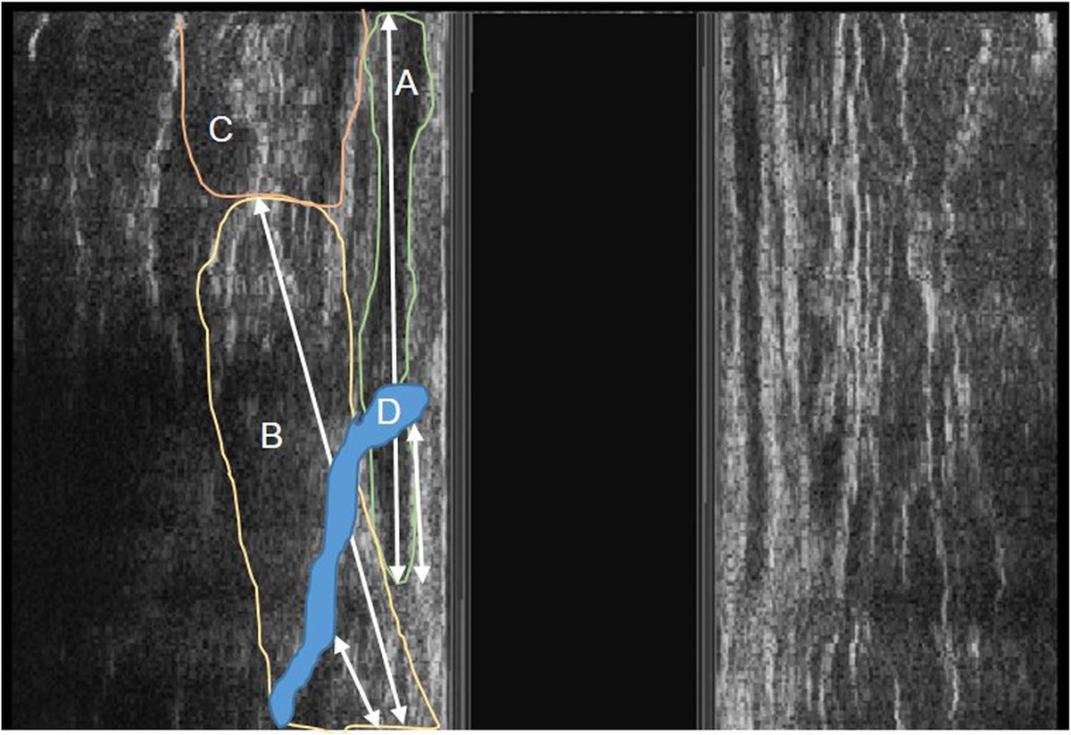 UCP Hospital Clínico Valencia (@clinicoucp) on Twitter photo ‼️‼️ Check out our most recent paper ‼️‼️ <a href="/StephGaBotello/">Stephanie Garcia-Botello</a> <a href="/MarinaGarces_/">Marina Garcés Albir</a> <a href="/davidmoro78/">David Moro-Valdezate</a> <a href="/VicentePlaMarti/">Vicente Pla Marti</a> <a href="/incliva_iis/">INCLIVA</a> <a href="/GVAclinic/">Hospital Clínic de València</a> <a href="/LAOS1860/">Langenbeck's Archives of Surgery</a> <a href="/UV_EG/">Universitat València</a>
Sphincter damage during fistulotomy for perianal fistulae and its relationship with faecal incontinence pubmed.ncbi.nlm.nih.gov/34468863/ ‼️‼️ Check out our most recent paper ‼️‼️ <a href="/StephGaBotello/">Stephanie Garcia-Botello</a> <a href="/MarinaGarces_/">Marina Garcés Albir</a> <a href="/davidmoro78/">David Moro-Valdezate</a> <a href="/VicentePlaMarti/">Vicente Pla Marti</a> <a href="/incliva_iis/">INCLIVA</a> <a href="/GVAclinic/">Hospital Clínic de València</a> <a href="/LAOS1860/">Langenbeck's Archives of Surgery</a> <a href="/UV_EG/">Universitat València</a>
Sphincter damage during fistulotomy for perianal fistulae and its relationship with faecal incontinence pubmed.ncbi.nlm.nih.gov/34468863/