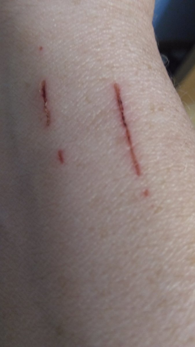 sunnstokes's tweet photo. Got to love cat scratches, Molly went to jump up onto my lap and pulled herself up using my arm! I don't think any of cats understand or care what ouch means!!!! #catscratchessuck #crazycatladyproblems #CatsOfTwitter https://t.co/w0wvbIBLvW