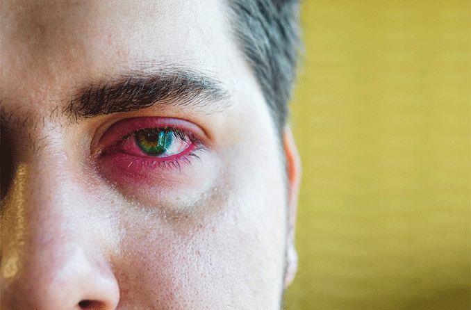 Eye inflammation is the eye’s response to irritation, infection or injury and can fall into several categories in terms of the cause and type. 

Check out this article to find out more and the treatments you can take to help with eye inflammation: allaboutvision.com/symptoms/eye-i…