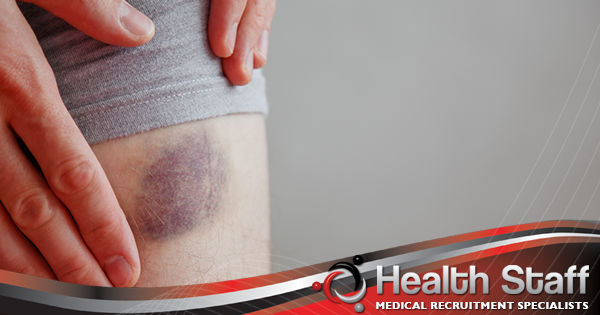 HS_HealthStaff's tweet photo. Some people find that they bruise so easily that they do not remember the original cause. Others develop large bruises after minor injuries or notice that their bruises take many weeks to heal. Find out what you need to know about bruising easily. https://t.co/IZyv9mNzuT https://t.co/j6iTBMOJVb
