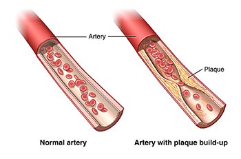 FirstDoctor's tweet photo. Cholesterol is a type of fat that is naturally made by your liver. You can also get it from certain foods.
In excess, it can get deposited on your blood vessel walls and clog them up leading to reduced blood flow.
The risk of this happening rises with age.
#CheckYourCholesterol https://t.co/E0Rx1I9fZq
