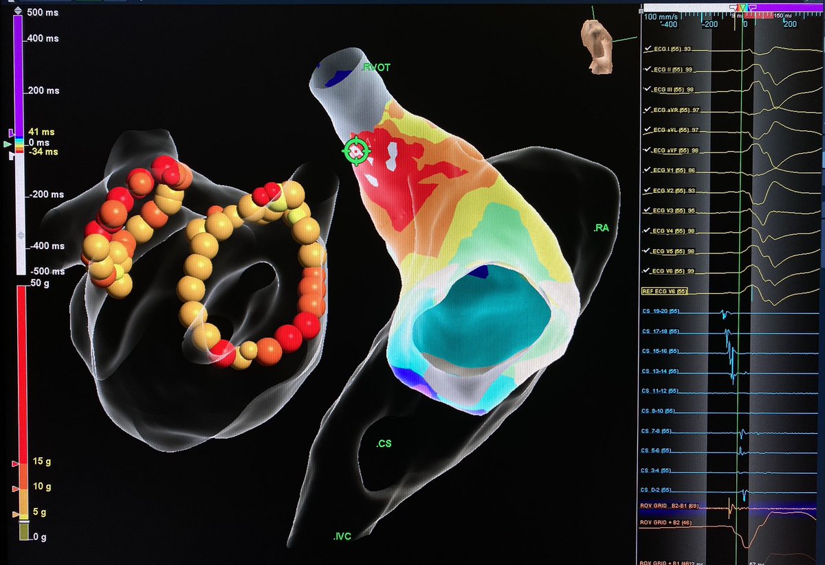 Getting Boris up to speed on cardiac mapping. Looks like he did a decent job covering this cool AF+PVC case #humanoidBoris