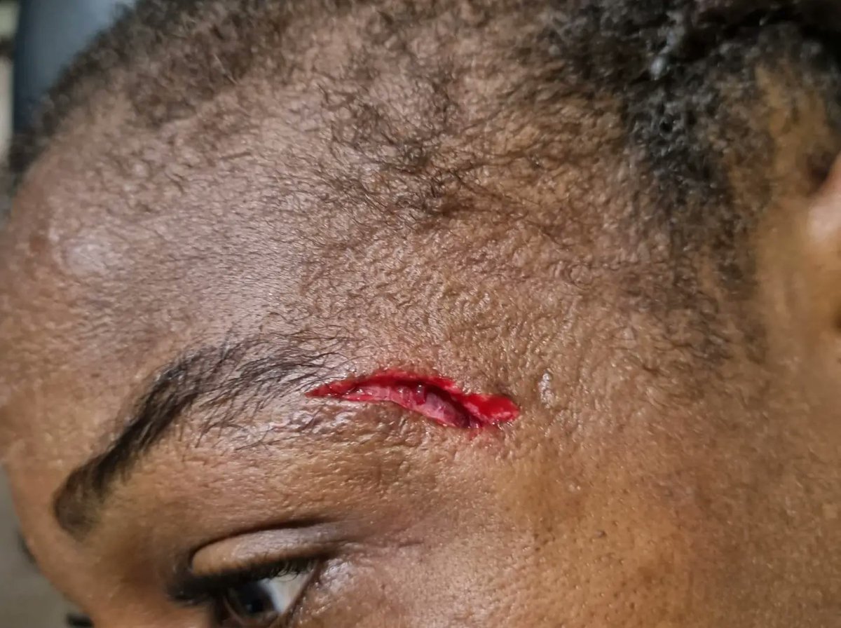 oparanozie9's tweet photo. Fighting through in my youth, for father land, sweat and blood. Appreciation to the medical team for being on deck hands on. #HeadCollision https://t.co/a5Si1AgORI