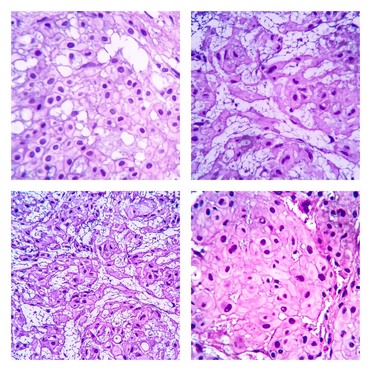 EIacovou's tweet image. A rare case of chordoma of the base of the skull/clivus presenting as nasopharyngeal mass. No brachyury antibody available. #pathology #twitterpath