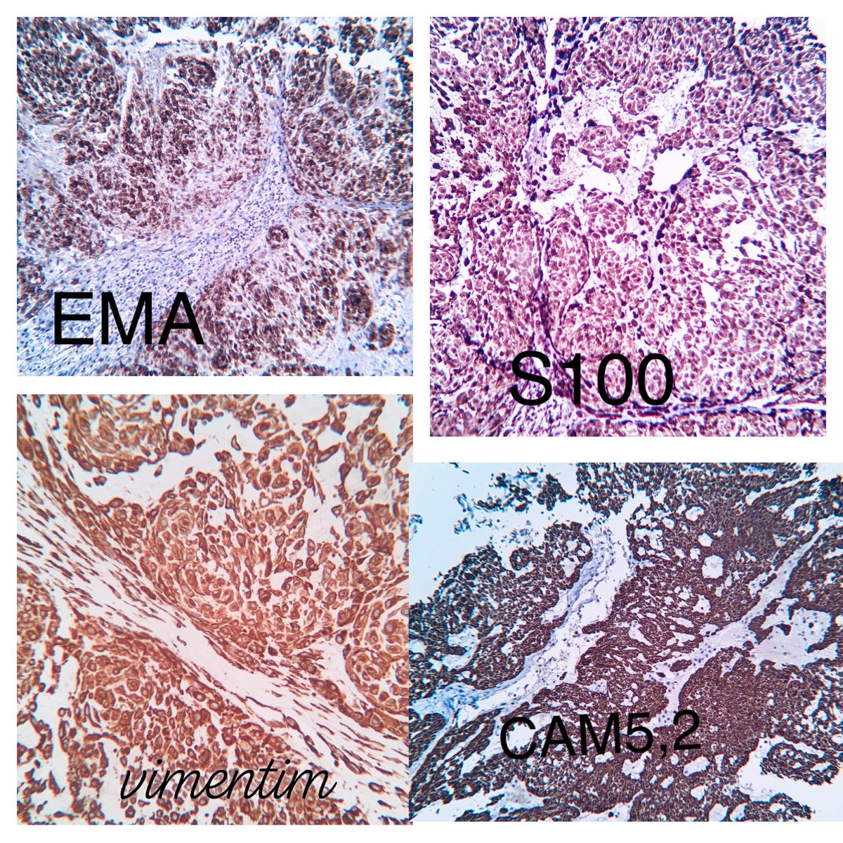EIacovou's tweet image. A rare case of chordoma of the base of the skull/clivus presenting as nasopharyngeal mass. No brachyury antibody available. #pathology #twitterpath