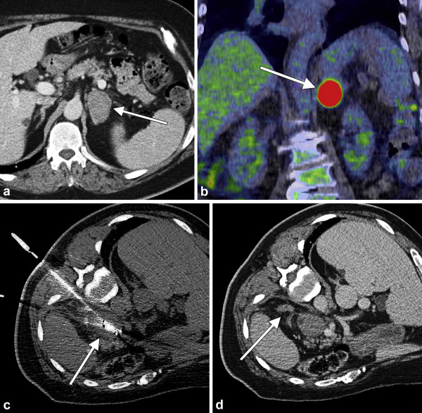 Percutaneous Image-Guided Thermal Ablation of Adrenal Metastasis from Melanoma: A Single-Institution Experience. ow.ly/jkyz50G8WtT <a href="/MayoRadiology/">Mayo Clinic Radiology</a> #irad <a href="/Welch_IO/">Brian Welch</a>