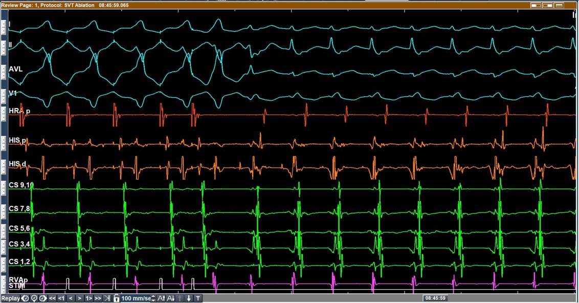 Syamkumar (@syamkumarmd) on Twitter photo Another "cool" 🔥🔥! #EPeeps #CardioTwitter I hope there is no controversy here 😉 . This time induced!
<a href="/ELabartkava/">Eugene Labartkava</a> <a href="/javadm20/">javad mikaeili</a> <a href="/chaturvedimd/">Vivek Chaturvedi</a> <a href="/ALFIEEP1/">ALBERTO ALFIE</a> <a href="/jeffrey_vinocur/">Jeffrey M Vinocur</a> <a href="/ftrae/">Piotr Futyma, MD</a> <a href="/UlhasDr/">Dr Ulhas Pandurangi</a> <a href="/adribaran/">Adrian Baranchuk MD FACC FRCPC FCCS FSIAC</a> <a href="/NimaZamiri/">Nima Zamiri</a> <a href="/bishoydf/">Bishoy Deif</a> <a href="/dog_oculus/">Mtwesi.Viwe.MD</a> <a href="/EPeeps_Bot/">EP_Bot</a> <a href="/MartowMartow/">Evan Martow</a> Another "cool" 🔥🔥! #EPeeps #CardioTwitter I hope there is no controversy here 😉 . This time induced!
<a href="/ELabartkava/">Eugene Labartkava</a> <a href="/javadm20/">javad mikaeili</a> <a href="/chaturvedimd/">Vivek Chaturvedi</a> <a href="/ALFIEEP1/">ALBERTO ALFIE</a> <a href="/jeffrey_vinocur/">Jeffrey M Vinocur</a> <a href="/ftrae/">Piotr Futyma, MD</a> <a href="/UlhasDr/">Dr Ulhas Pandurangi</a> <a href="/adribaran/">Adrian Baranchuk MD FACC FRCPC FCCS FSIAC</a> <a href="/NimaZamiri/">Nima Zamiri</a> <a href="/bishoydf/">Bishoy Deif</a> <a href="/dog_oculus/">Mtwesi.Viwe.MD</a> <a href="/EPeeps_Bot/">EP_Bot</a> <a href="/MartowMartow/">Evan Martow</a>