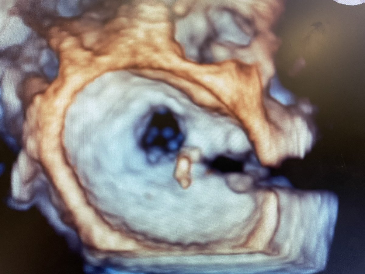 Ditongaje's tweet photo. Transcatheter mitral valve repair with mitraclip. Flail A3, 2 NTR clip , reduction to trivial to mild MR, MG 4-5 mmHg. #mitraclip #structuralheartintervention #cardiologist https://t.co/rEageNGIPx