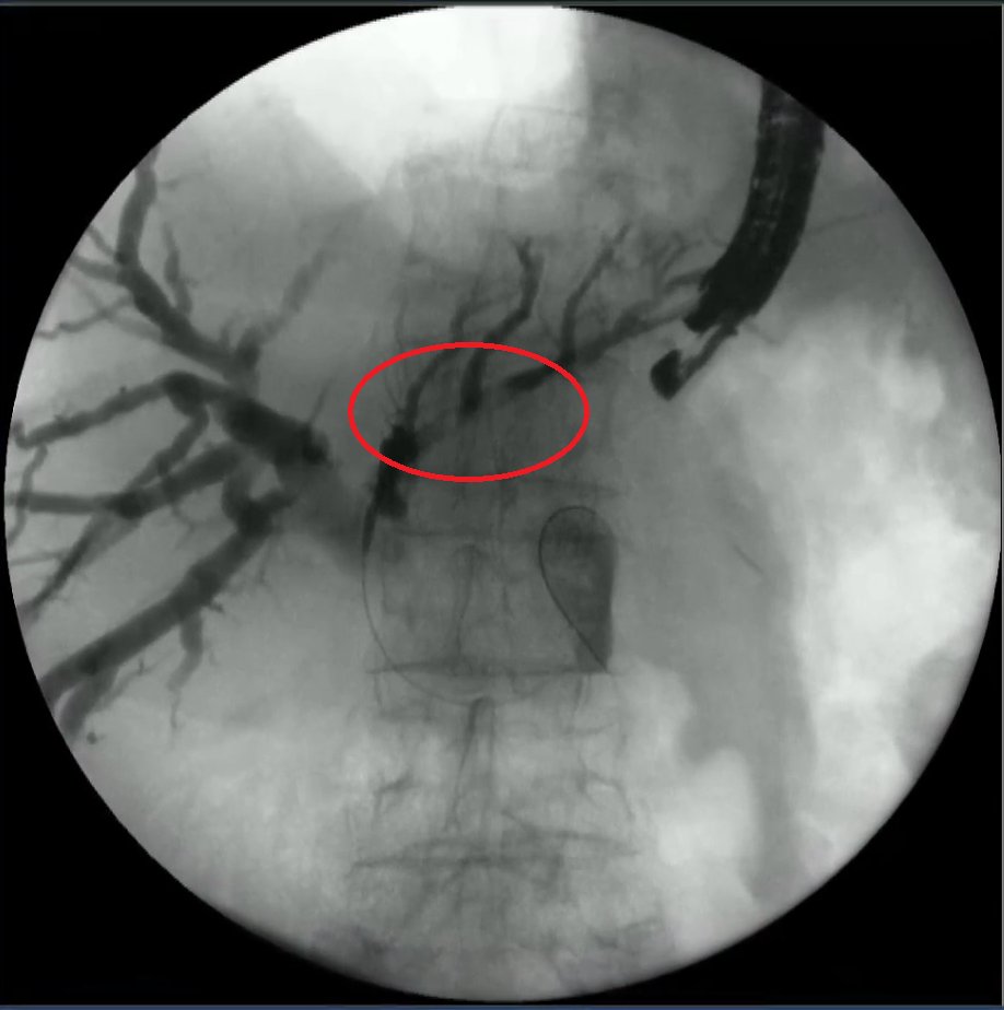 STEndoscopia's tweet photo. Compartimos estas imágenes que nos llegan desde el curso EUS-ENDO 2021 en donde se está realizando en #Directo una Hepaticogastrostomía con la Prótesis #GIOBOR™ de @taewoongmedical.

#STEndoscopia #TaewoongMedical #stenting #EUS #gastroenterology #endoscopia #endoscopy https://t.co/bJaXjD9wVV